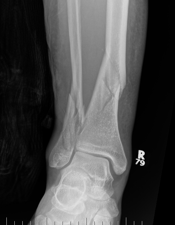 distal tibia fibula fracture