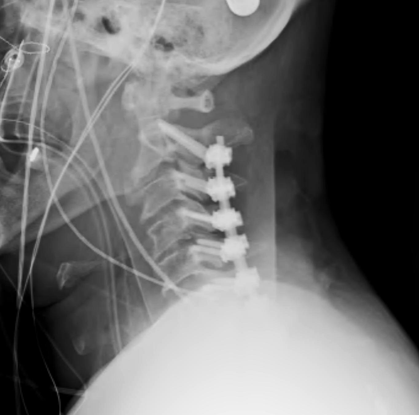 stage 1 slipped disk xray