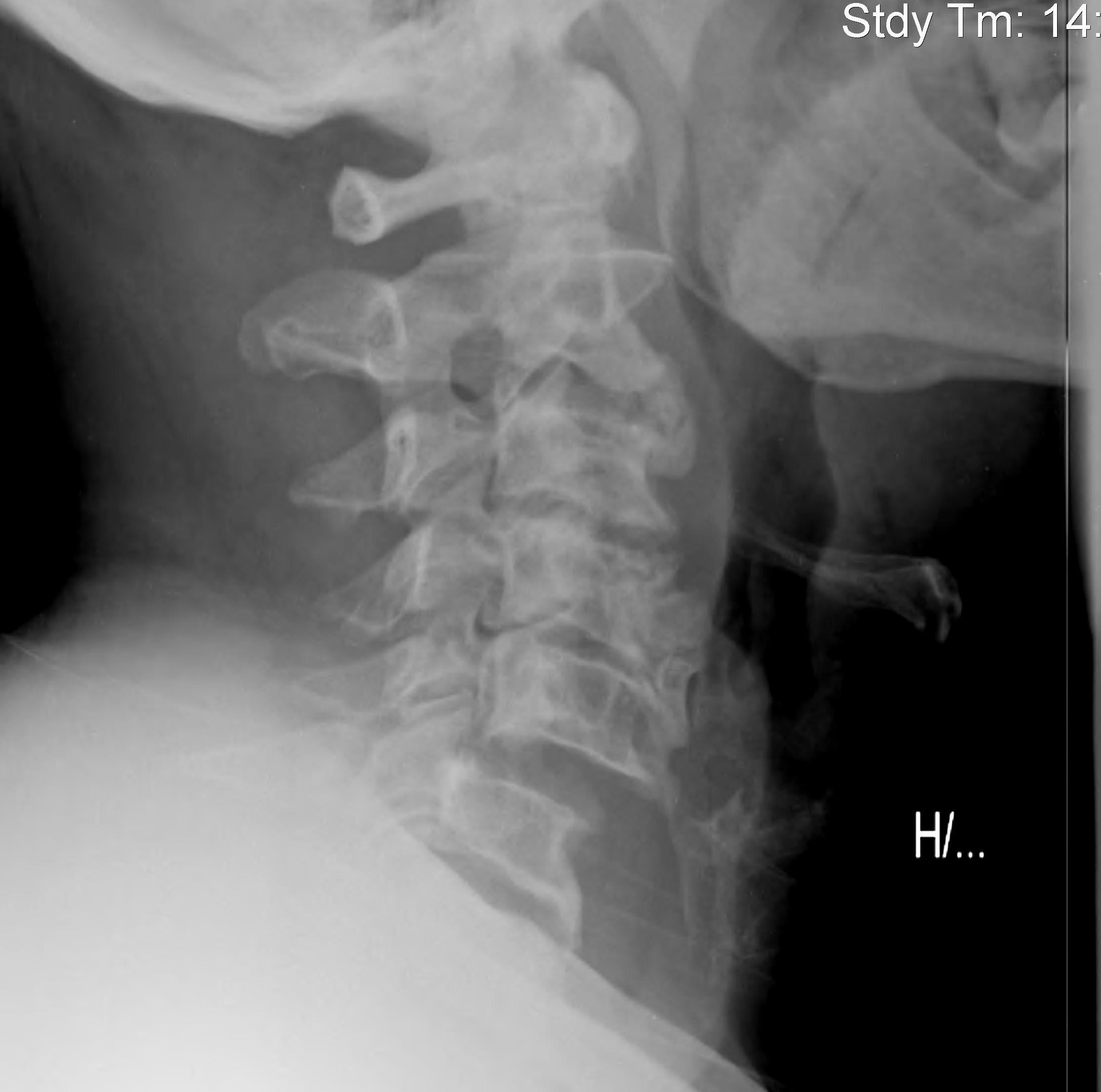 stage 1 slipped disk xray