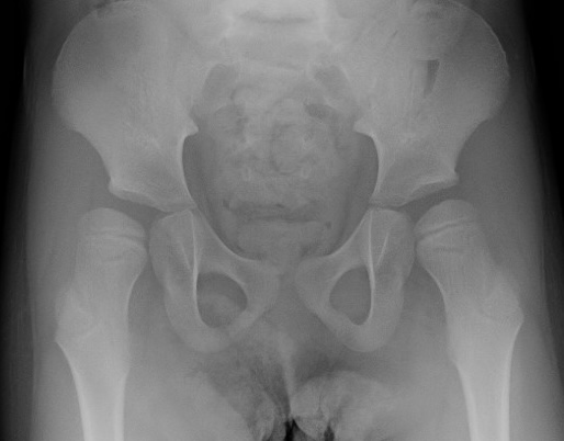 CP hip