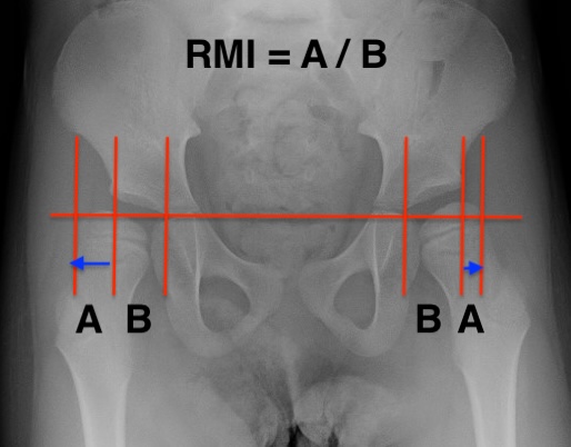 RMI