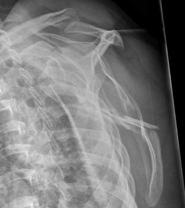 scapula