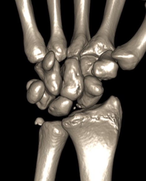 RC