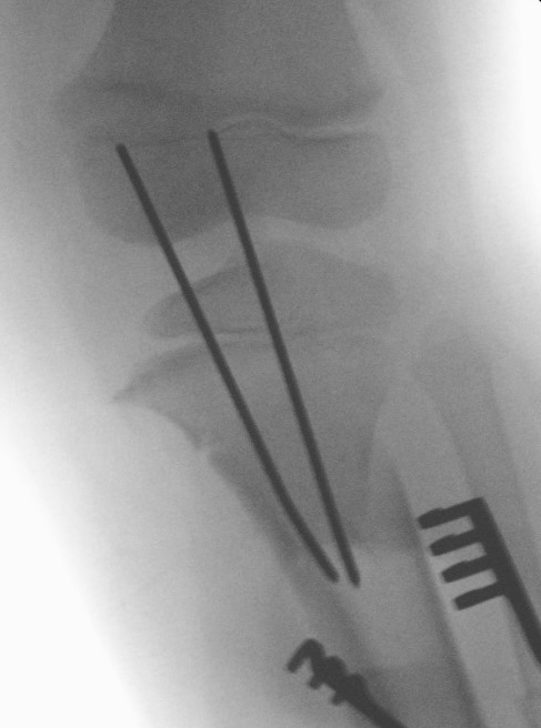 Blounts osteotomy