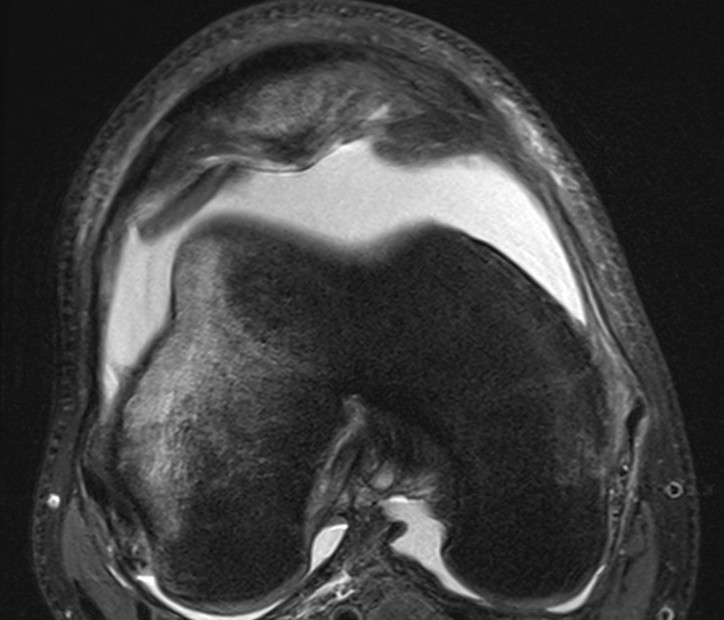 Patella