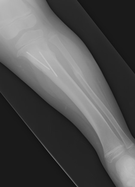 Blounts osteotomy