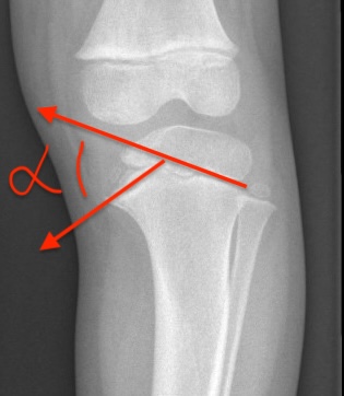 Metaphyseal angle