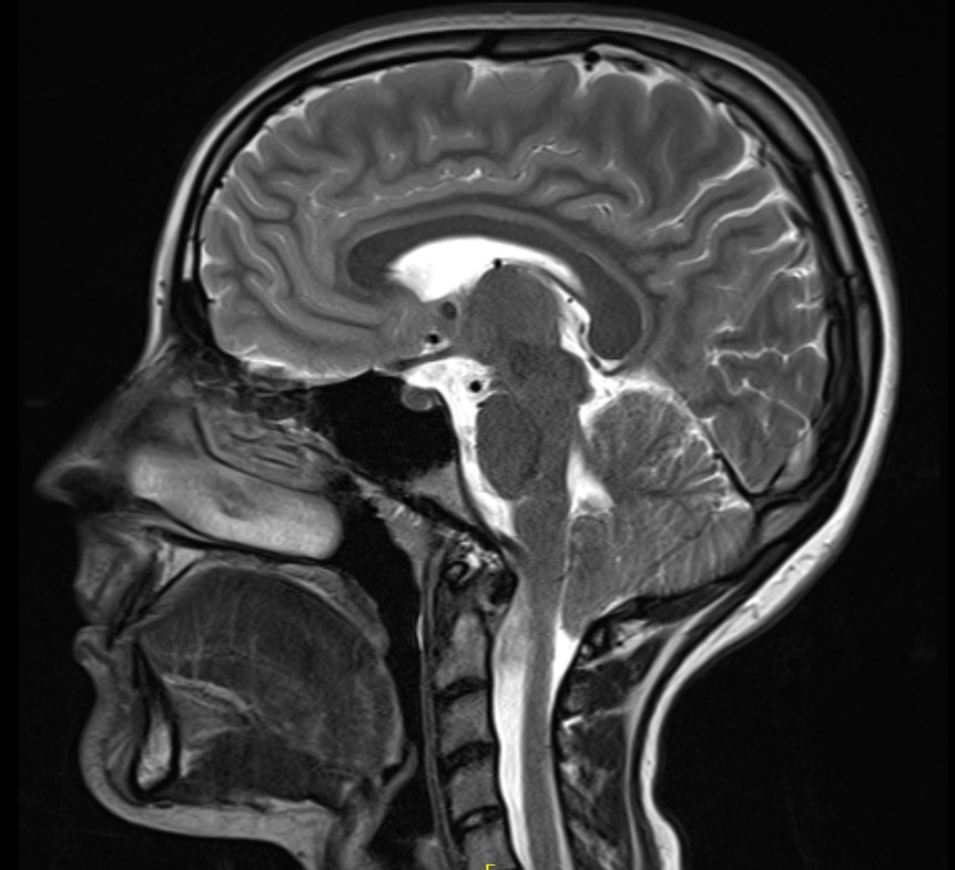Chiari malformation