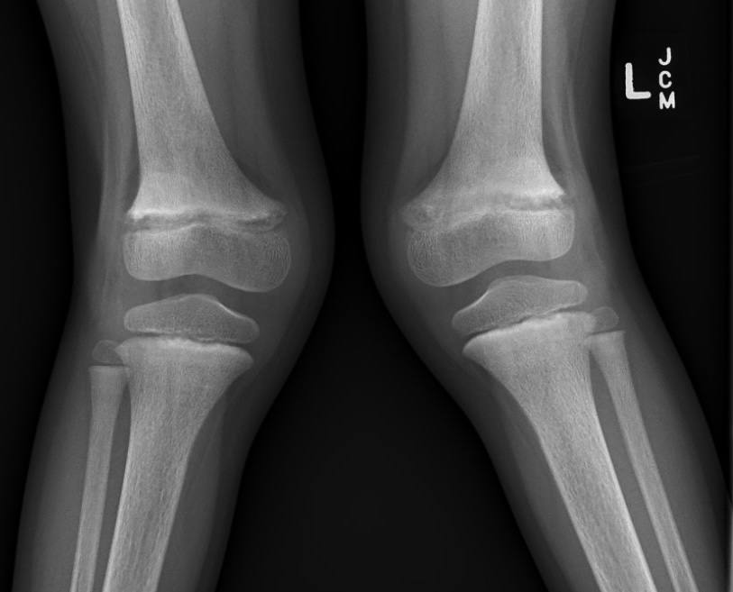 Rickets