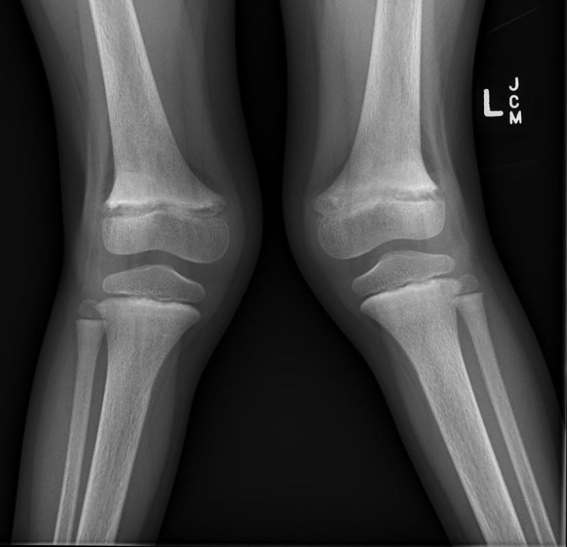 valgus malalignment