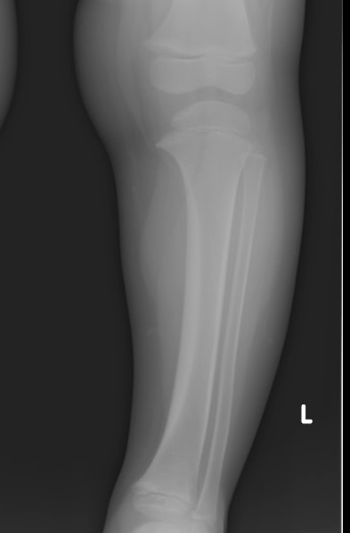 Blounts osteotomy