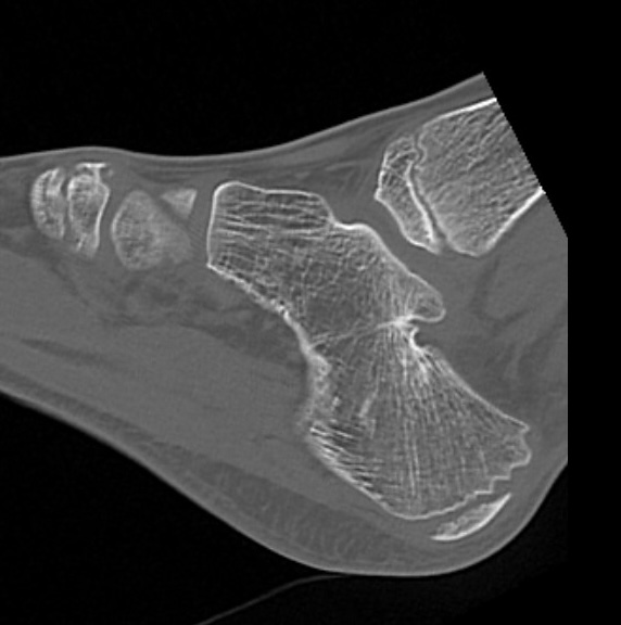 fibula hemimelia