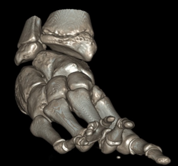 fibula hemimelia