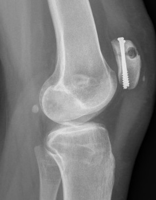 Fracture