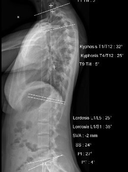 Lateral xray