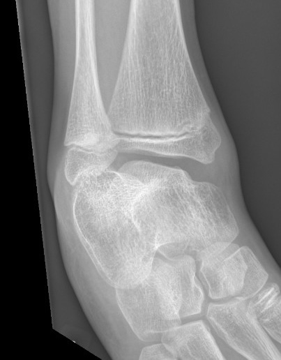 fibula hemimelia