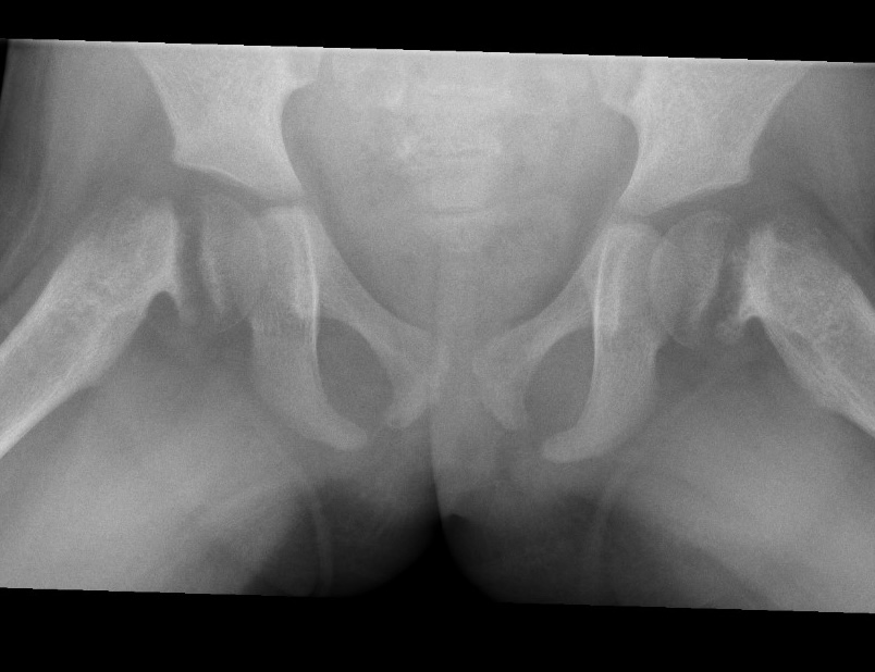 Rickets hips