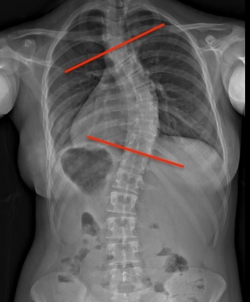 End vertebrae