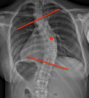 Apical vertebrae