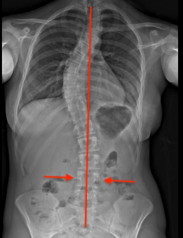Stable vertebrae