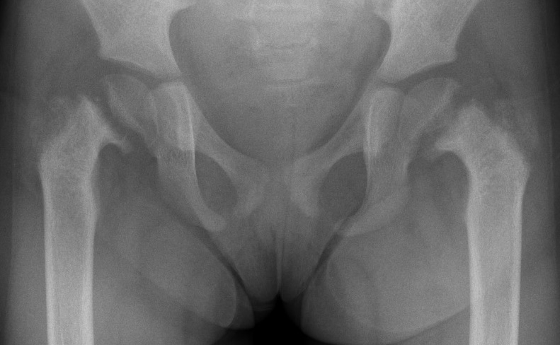 Rickets hips