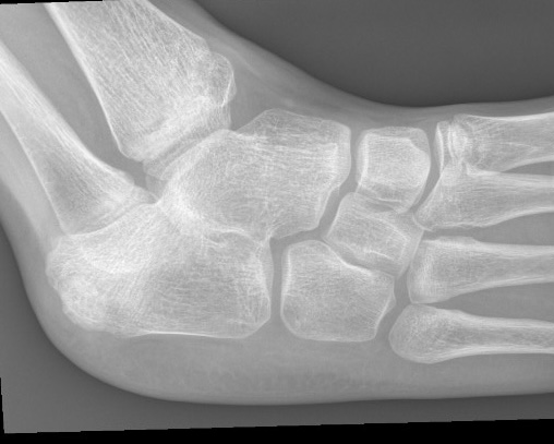 fibula hemimelia