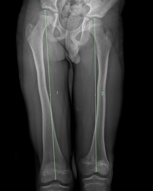 Short femur