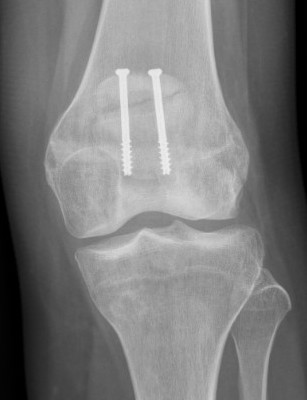 Fracture