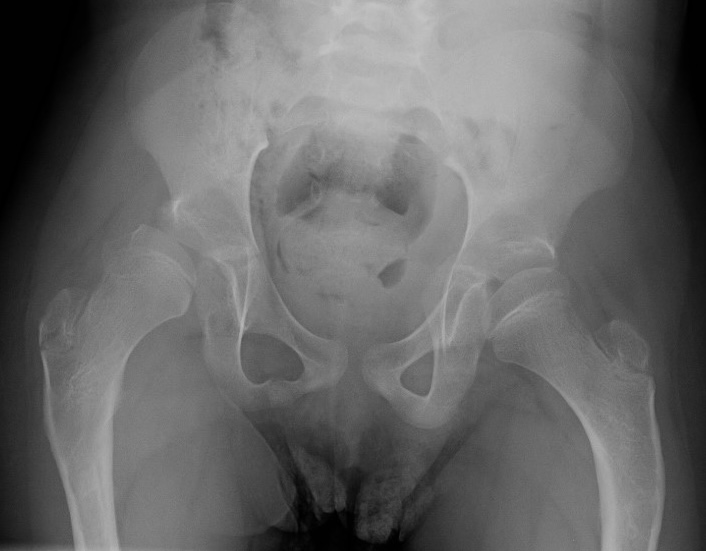CP hip