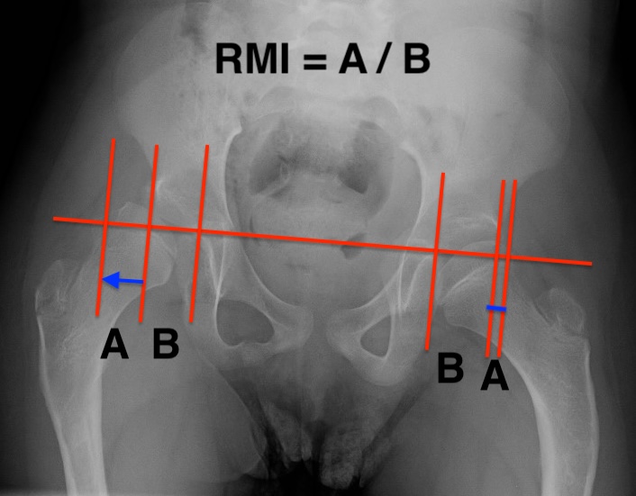 RMI