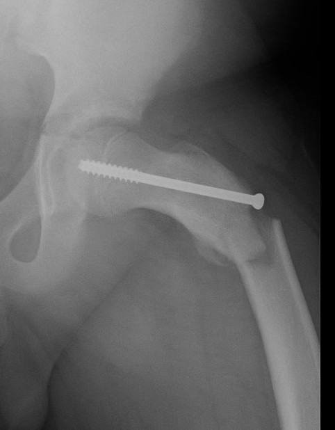 fracture