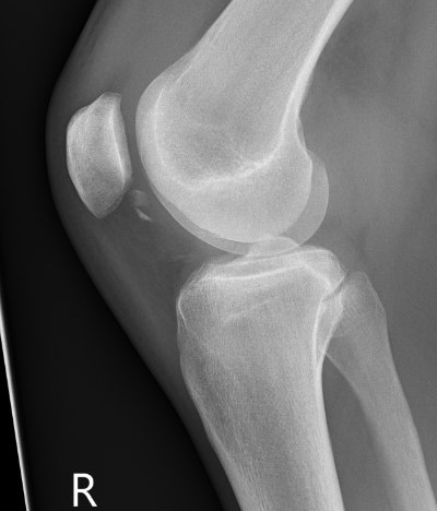 OC fracture