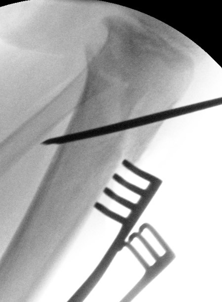 Blounts osteotomy
