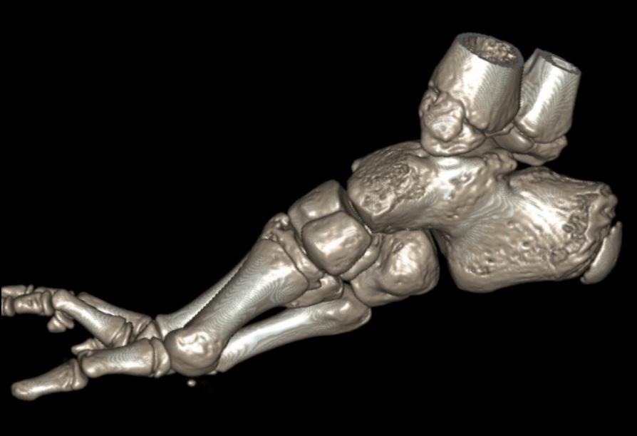 fibular hemimelia