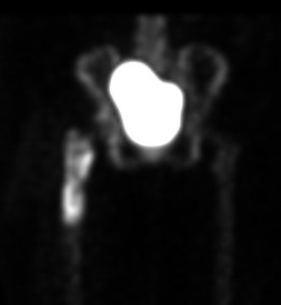 Infected bone scan
