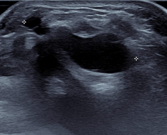 ganglion us