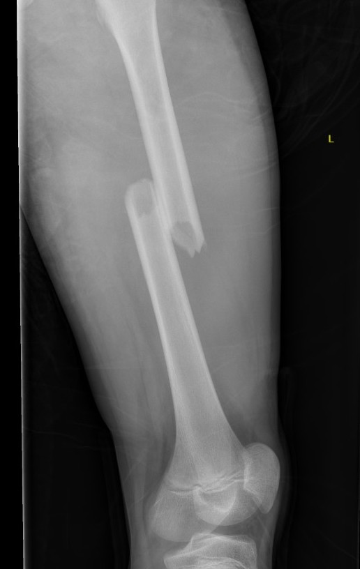 Femur