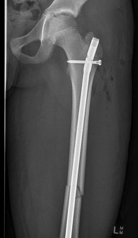 Femur