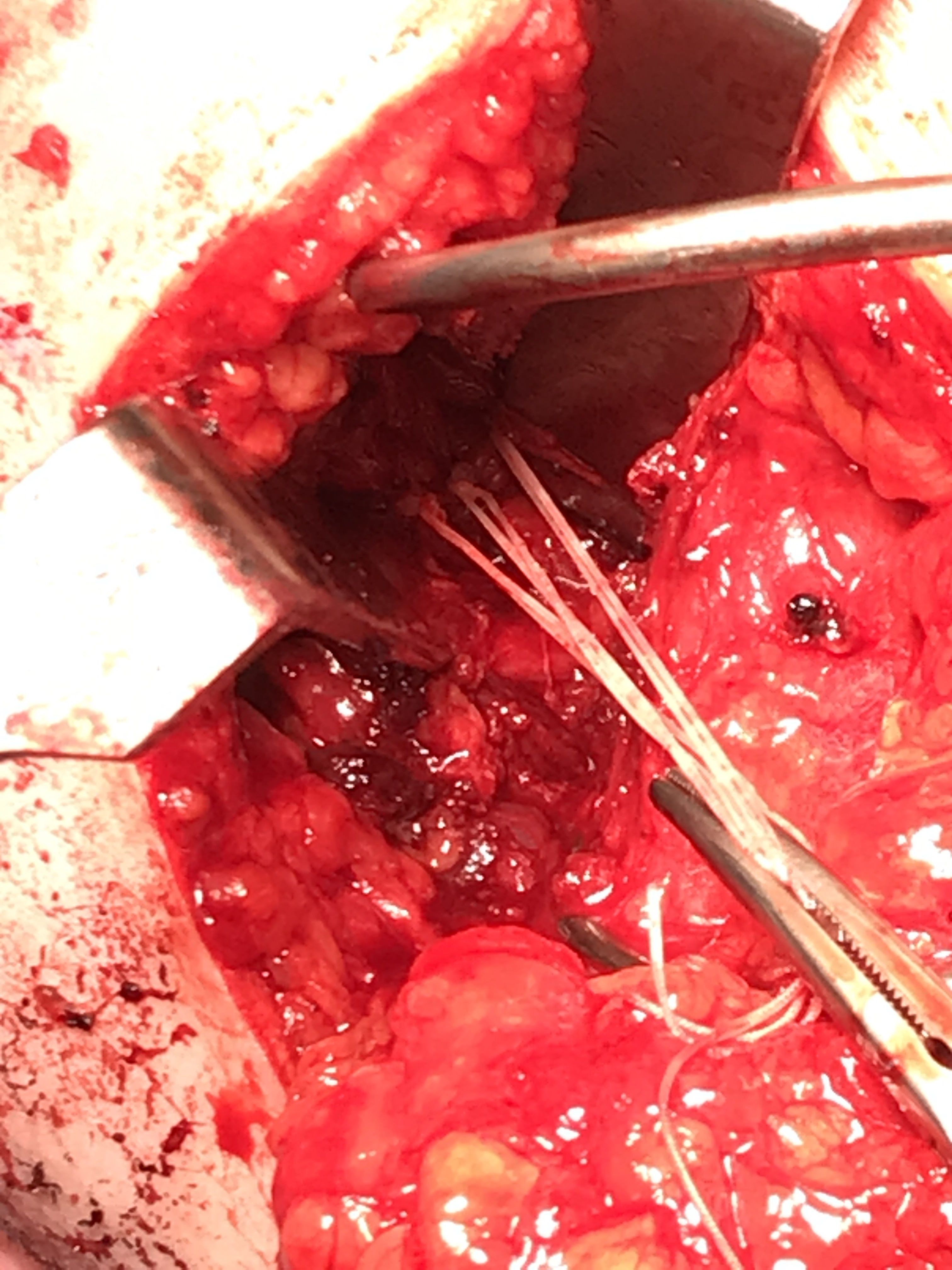post shoulder