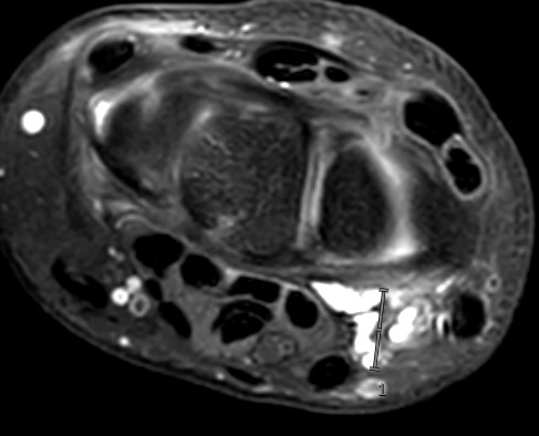 volar ganglion