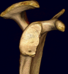 bony bankart