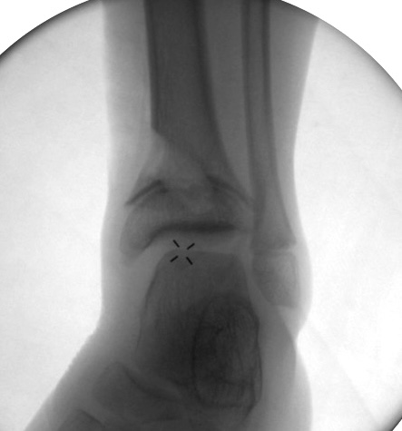 Epiphysiolysis