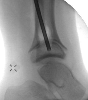Epiphysiolysis
