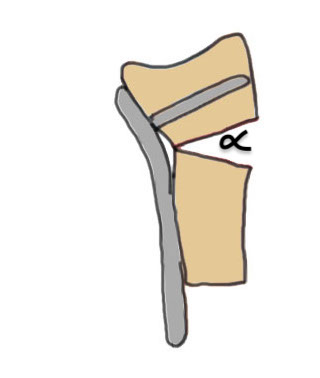Volar osteotomy
