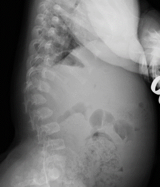 achondroplasia