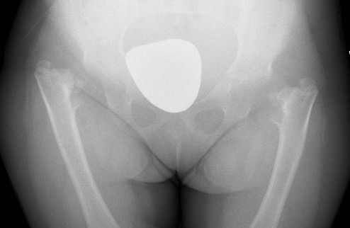 achondroplasia