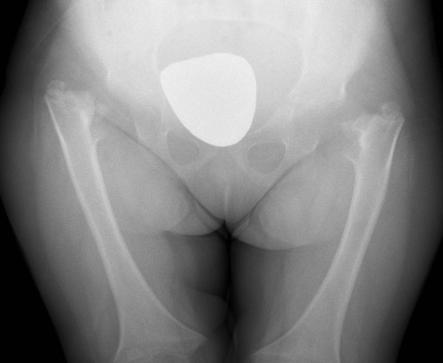 Achondroplasia