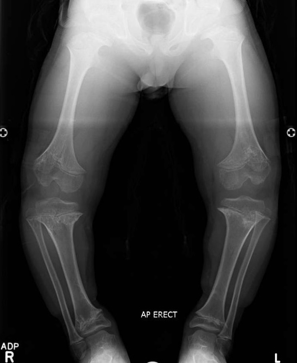 Achondrodysplasia