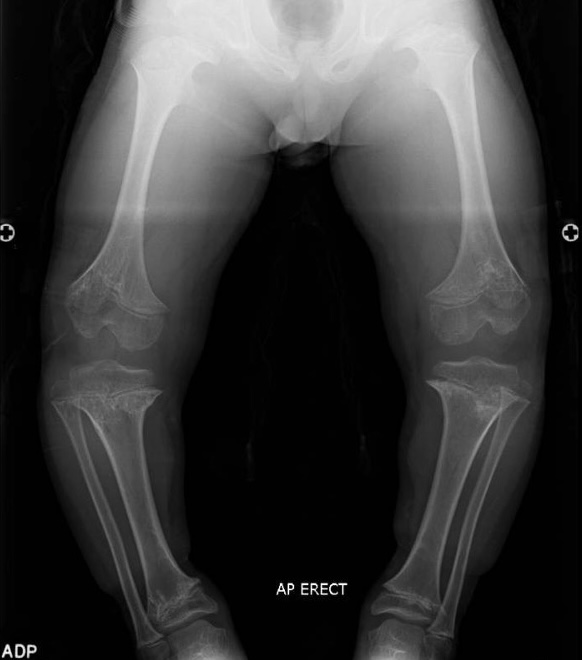 Achondroplasia