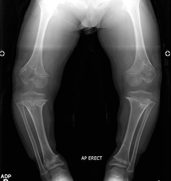Achondroplasia